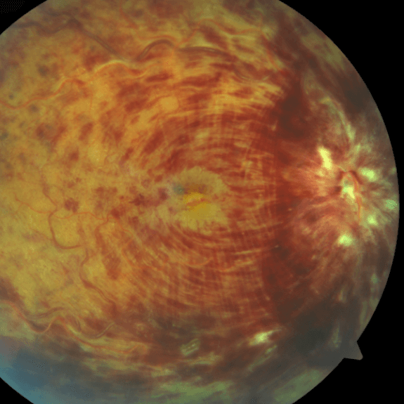 Oclusao Venosa da retina