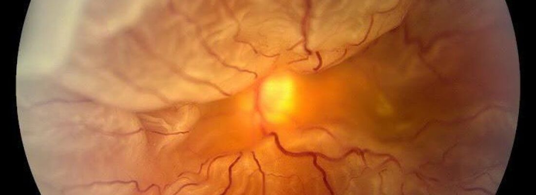 descolamento de retina